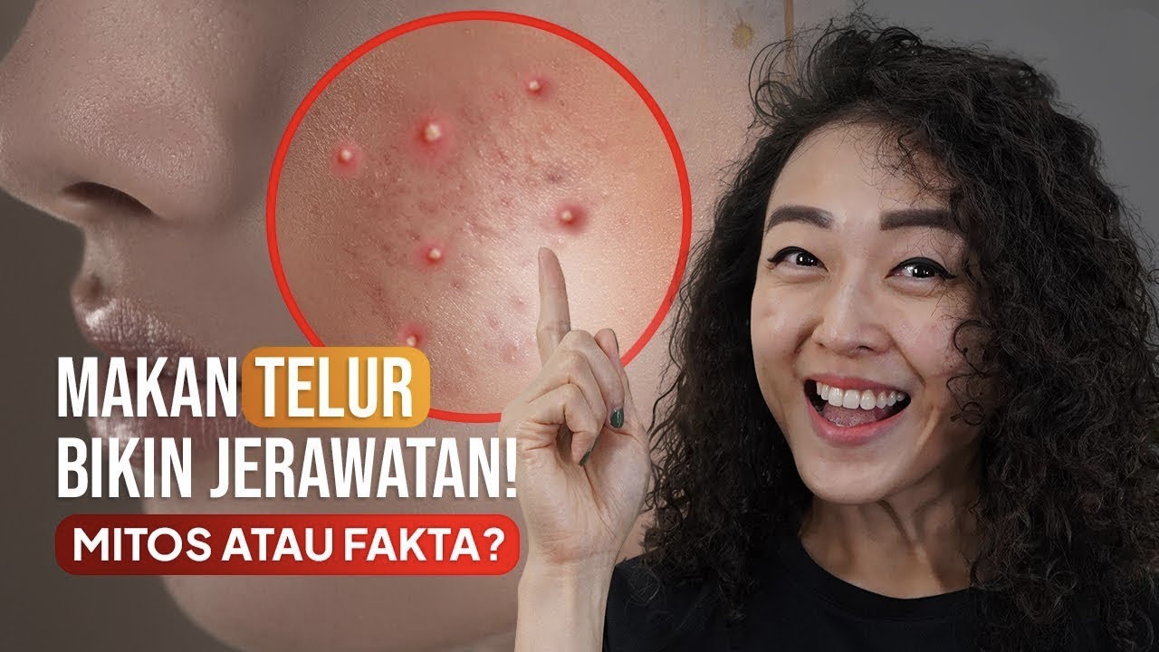 Mitos dan Fakta Seputar Telur, Benarkah Bisa Menyebabkan Timbulnya Jerawat?