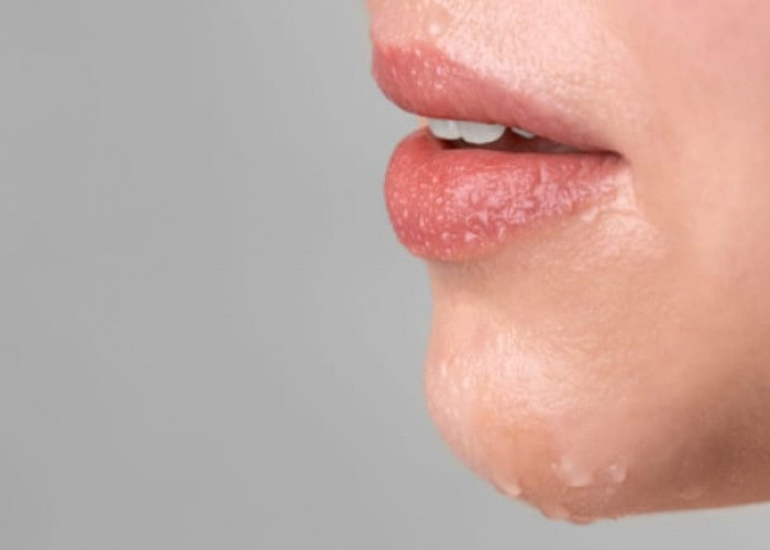 Bibir Sering Pecah Akibat Berpuasa, Tenang Ini 5 Cara Mengatasinya