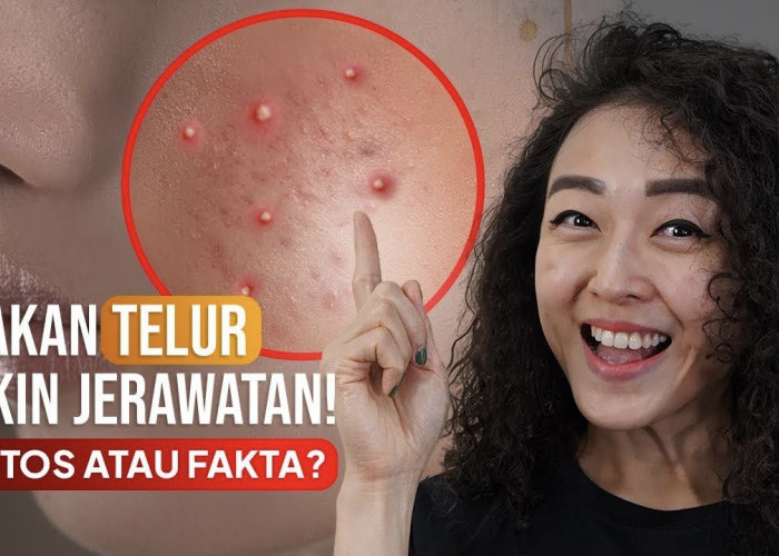 Mitos dan Fakta Seputar Telur, Benarkah Bisa Menyebabkan Timbulnya Jerawat?