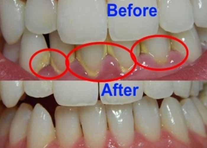 Cara Mudah Menghilangkan Plak Pada Gigi, Lakukan Sekarang Sebelum Gigi Anda Rusak